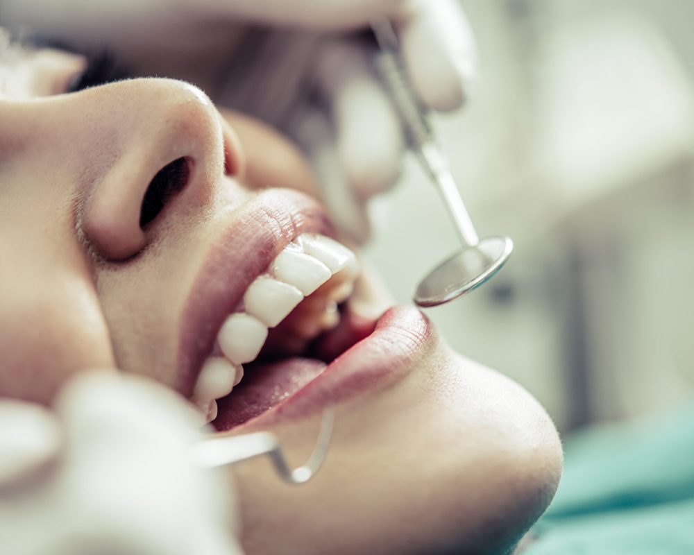 Blanqueamiento dental